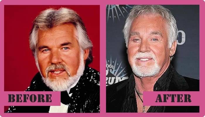 Kenny-Rogers-Plastic-Surgery-Before-And-After.jpg